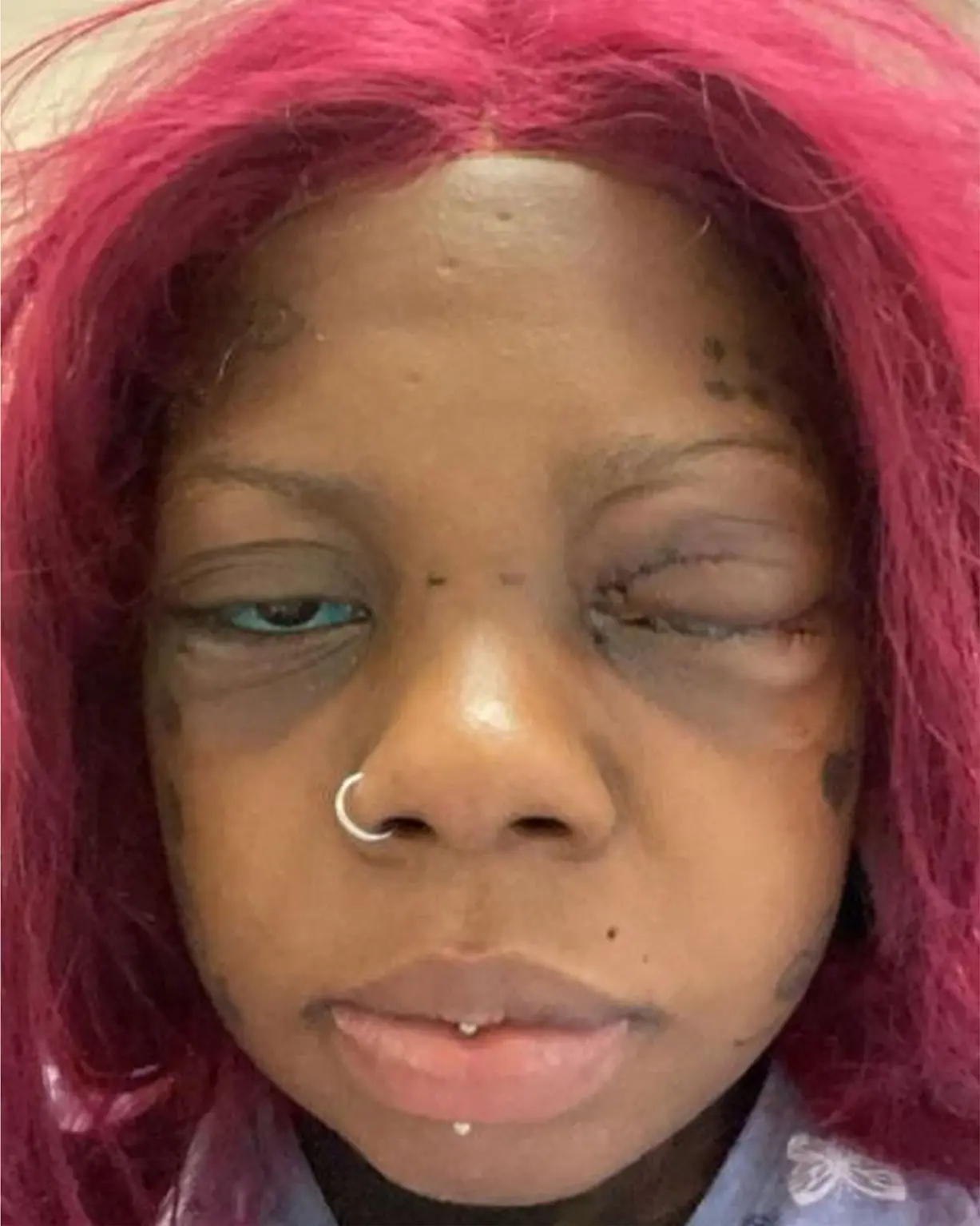 Mother on the verge of blindness after getting tattoos on both eyeballs to imitate Model [photos]